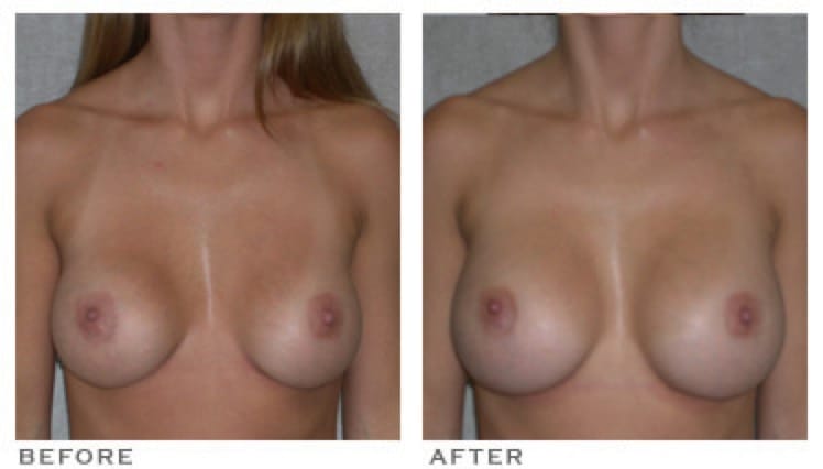 Breast Implant Size Change