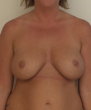 Breast Implant Revision Before and After | CIARAVINO Plastic Surgery