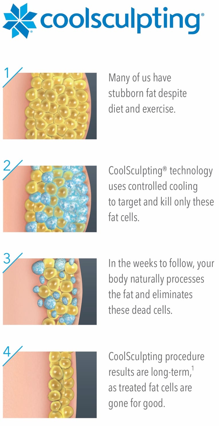 CoolSculpting Houston