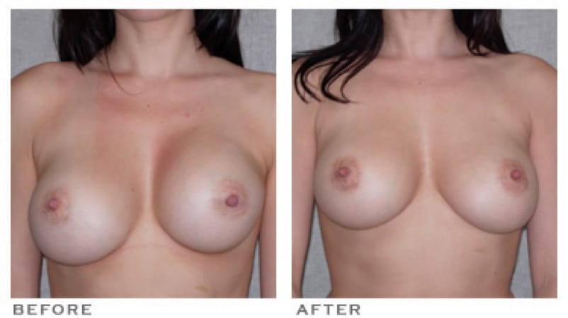 Breast Asymmetry Houston