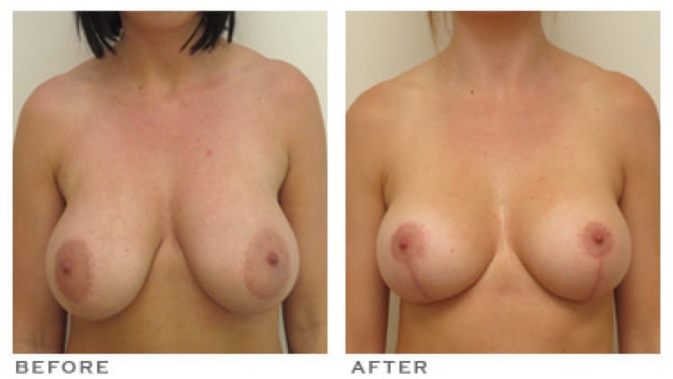 Breast Ptosis Houston