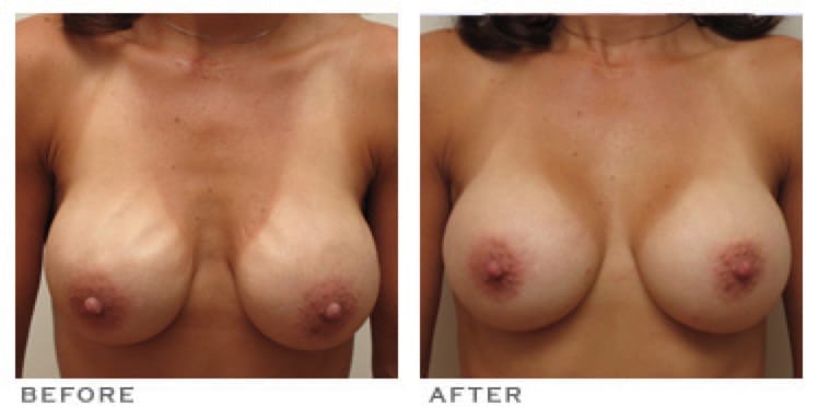 Breast Implant Rippling Houston