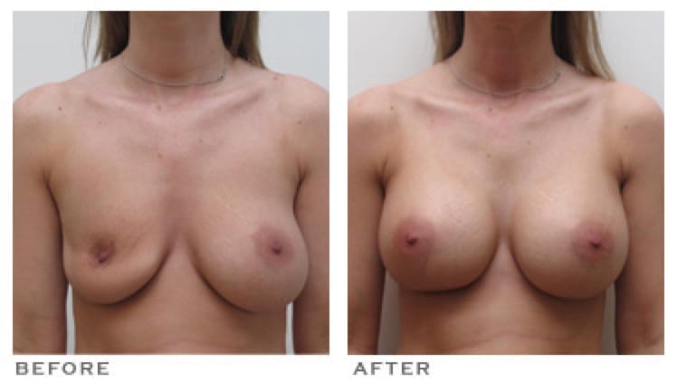 Breast Implant Rupture Houston