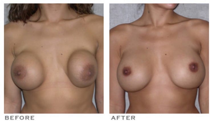 Capsular Contracture Houston