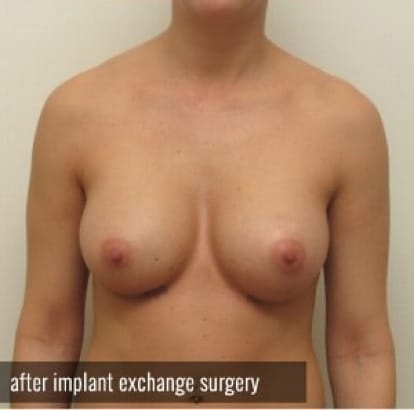 Breast Implant Deflation Houston