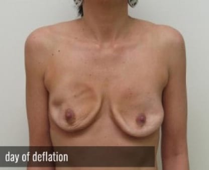Breast Implant Deflation Houston