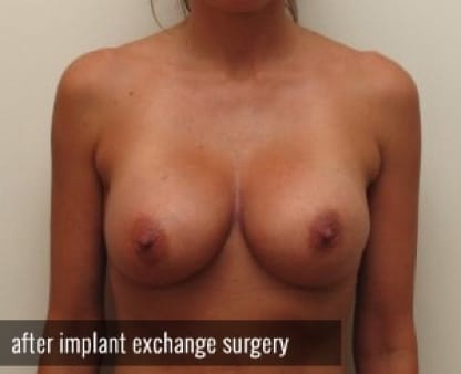 Breast Implant Deflation Houston