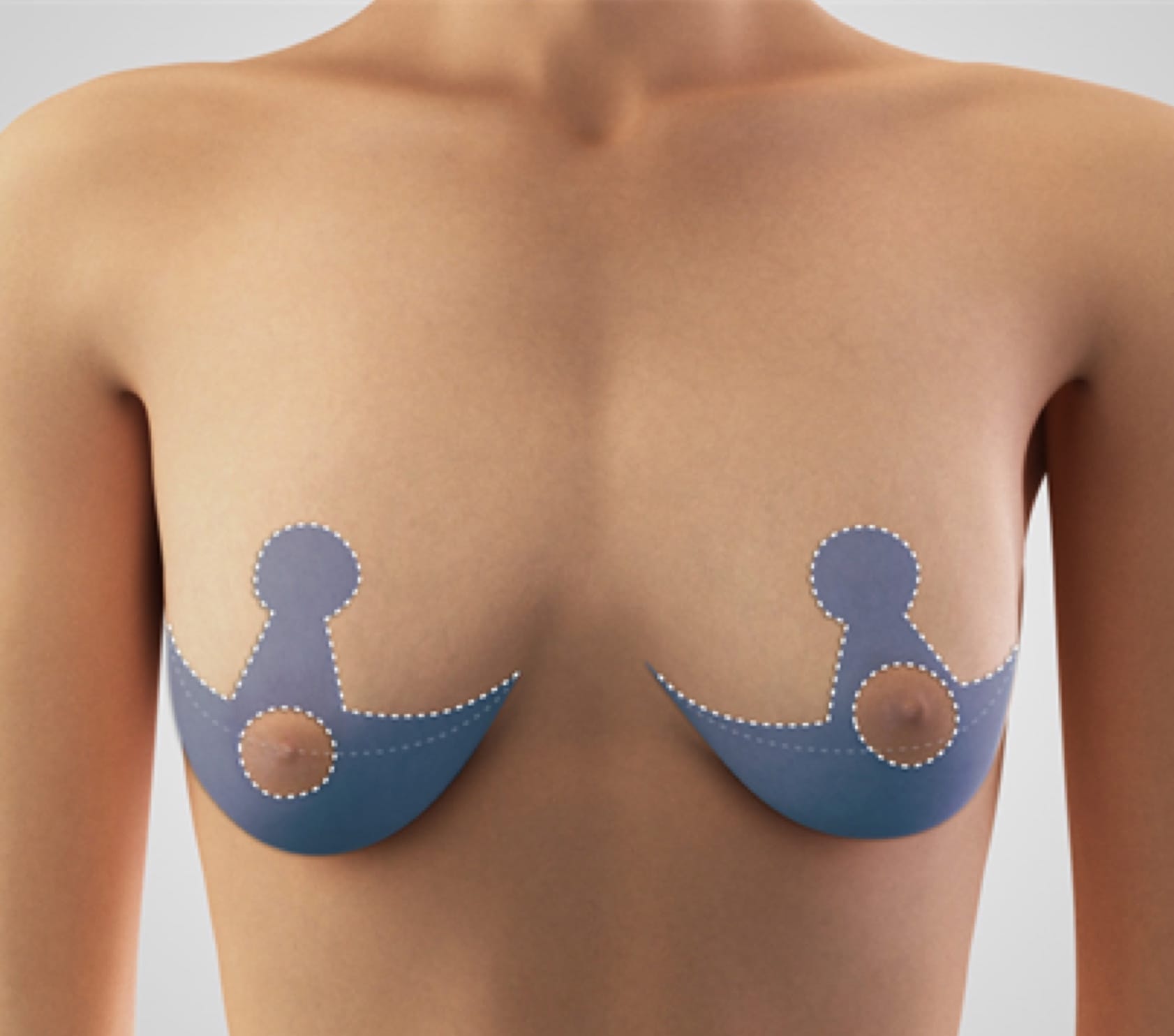 Breast Implant Deflation Houston