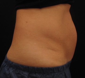 Coolsculpting Before and After | CIARAVINO Plastic Surgery