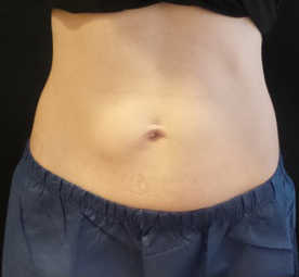 Coolsculpting Before and After | CIARAVINO Plastic Surgery
