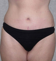 Tummy Tuck Before and After | CIARAVINO Plastic Surgery