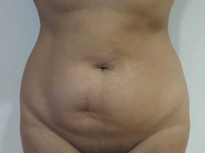 Tummy Tuck Before and After | CIARAVINO Plastic Surgery