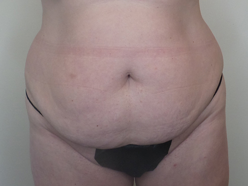 Tummy Tuck Before and After | CIARAVINO Plastic Surgery