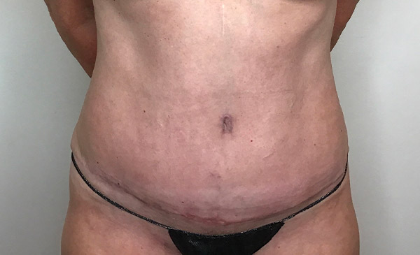 Tummy Tuck Before and After | CIARAVINO Plastic Surgery