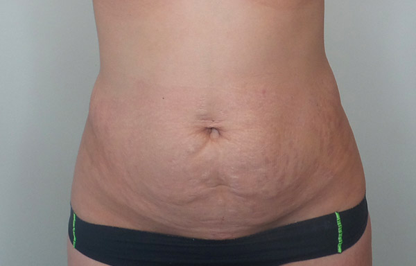 Tummy Tuck Before and After | CIARAVINO Plastic Surgery