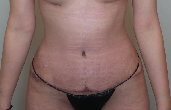 Tummy Tuck Before and After | CIARAVINO Plastic Surgery