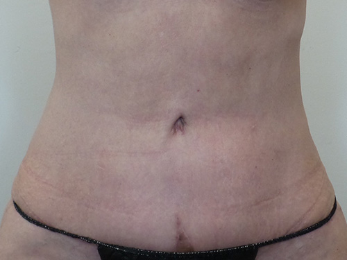 Tummy Tuck Before and After | CIARAVINO Plastic Surgery