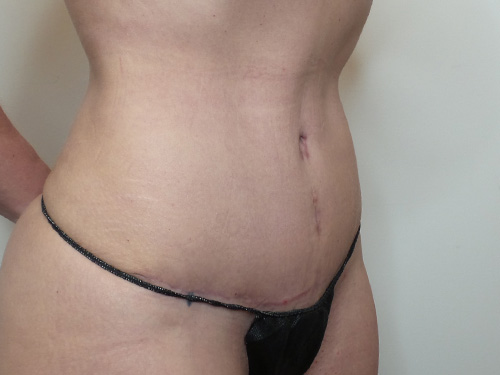 Tummy Tuck Before and After | CIARAVINO Plastic Surgery