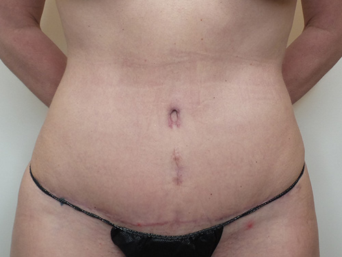 Tummy Tuck Before and After | CIARAVINO Plastic Surgery