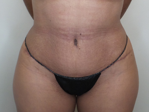 Tummy Tuck Before and After | CIARAVINO Plastic Surgery