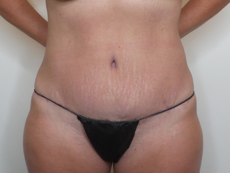 Tummy Tuck Before and After | CIARAVINO Plastic Surgery