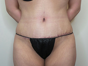 Tummy Tuck Before and After | CIARAVINO Plastic Surgery