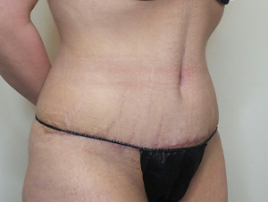 Tummy Tuck Before and After | CIARAVINO Plastic Surgery
