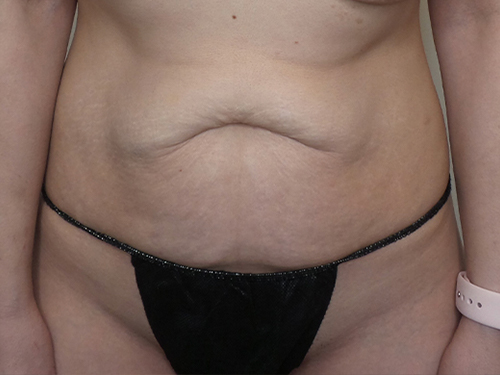 Tummy Tuck Before and After | CIARAVINO Plastic Surgery