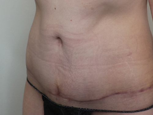 Tummy Tuck Before and After | CIARAVINO Plastic Surgery