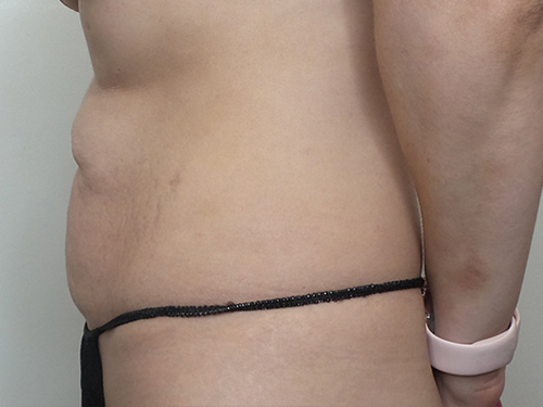 Tummy Tuck Before and After | CIARAVINO Plastic Surgery