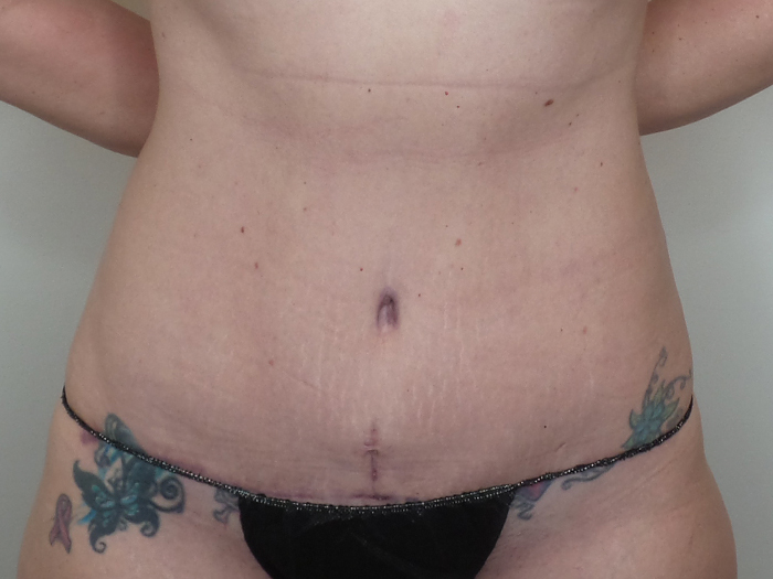 Tummy Tuck Before and After | CIARAVINO Plastic Surgery