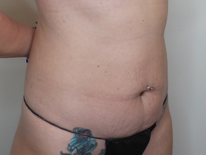 Tummy Tuck Before and After | CIARAVINO Plastic Surgery