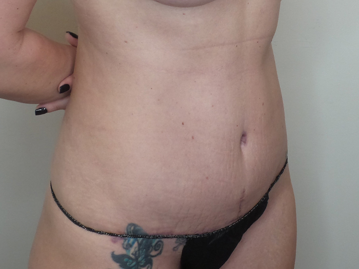 Tummy Tuck Before and After | CIARAVINO Plastic Surgery