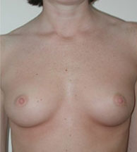 Breast Augmentation Saline Implants Before and After | CIARAVINO Plastic Surgery & Med Spa