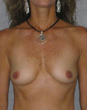 Breast Augmentation Saline Implants Before and After | CIARAVINO Plastic Surgery & Med Spa