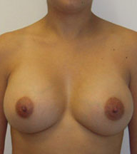 Breast Augmentation Saline Implants Before and After | CIARAVINO Plastic Surgery & Med Spa