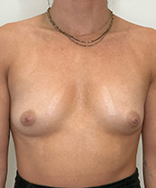 Breast Augmentation Silicone Implants Before and After | CIARAVINO Plastic Surgery & Med Spa