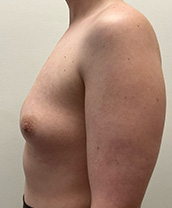 Breast Augmentation Silicone Implants Before and After | CIARAVINO Plastic Surgery & Med Spa