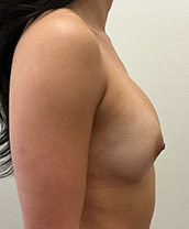 Breast Augmentation Silicone Implants Before and After | CIARAVINO Plastic Surgery & Med Spa