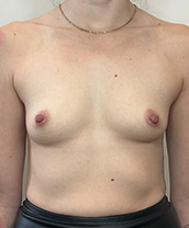 Breast Augmentation Silicone Implants Before and After | CIARAVINO Plastic Surgery & Med Spa