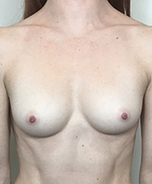 Breast Augmentation Silicone Implants Before and After | CIARAVINO Plastic Surgery & Med Spa