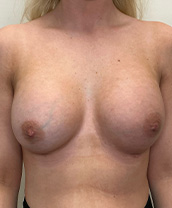 Breast Augmentation Silicone Implants Before and After | CIARAVINO Plastic Surgery & Med Spa