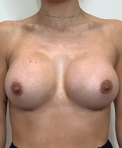 Breast Augmentation Silicone Implants Before and After | CIARAVINO Plastic Surgery & Med Spa