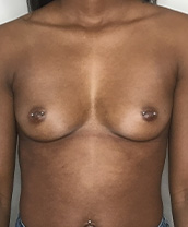 Breast Augmentation Silicone Implants Before and After | CIARAVINO Plastic Surgery & Med Spa