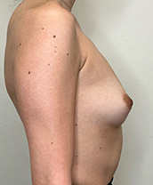 Breast Augmentation Silicone Implants Before and After | CIARAVINO Plastic Surgery & Med Spa
