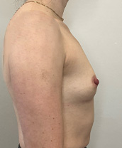 Breast Augmentation Silicone Implants Before and After | CIARAVINO Plastic Surgery & Med Spa