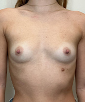 Breast Augmentation Silicone Implants Before and After | CIARAVINO Plastic Surgery & Med Spa