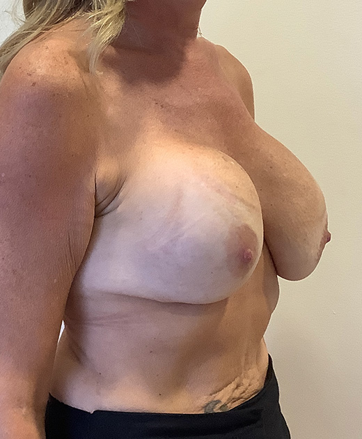 Breast Implant Revision Before and After | CIARAVINO Plastic Surgery & Med Spa