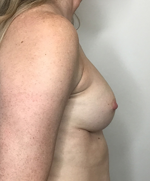 Breast Implant Revision Before and After | CIARAVINO Plastic Surgery & Med Spa