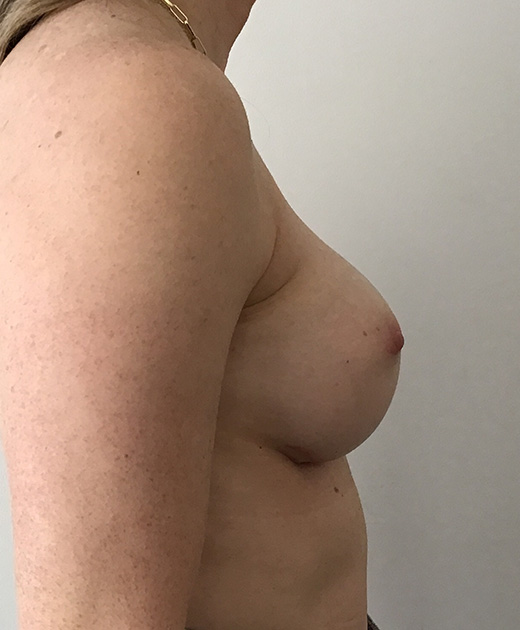 Breast Implant Revision Before and After | CIARAVINO Plastic Surgery & Med Spa